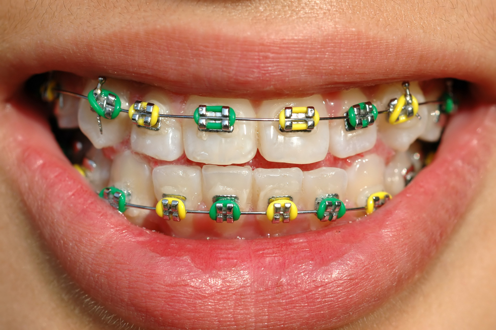 Dental Braces