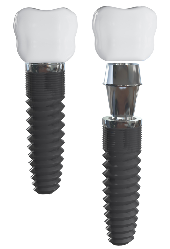 Dental Implants